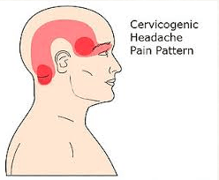 Headache originating in the neck.