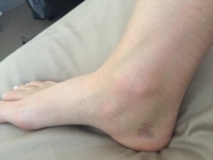 podiatry shepp ankle bruising